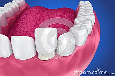 Dental Veneers: Porcelain Veneer installation Procedure. Cartoon Illustration