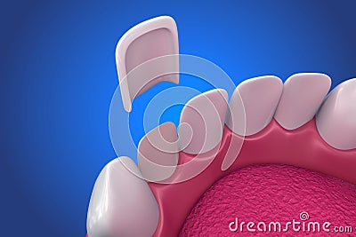 Dental Veneers: Porcelain Veneer installation Procedure. illustration Cartoon Illustration