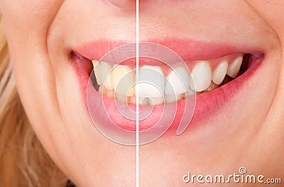 Dental Whitening Stock Photo