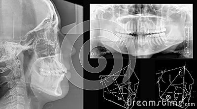 Dental X-Ray Stock Photo