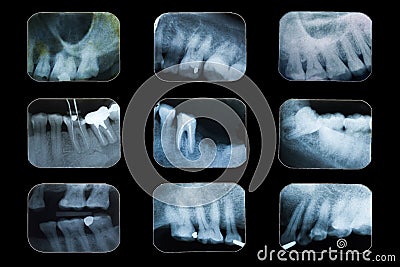 Dental x-ray film. Stock Photo