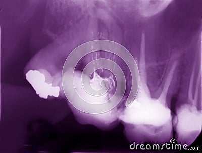 Dental x-ray film showing cured teeth Stock Photo