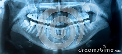 Dental X-Ray panoramic Stock Photo