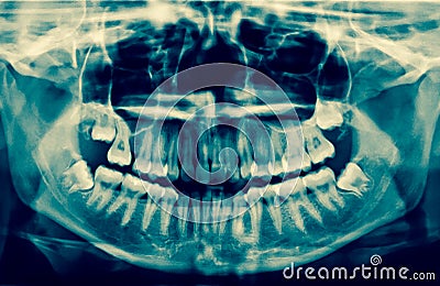 Dental X-Ray. A panoramic x-ray of a mouth, with intact wisdom t Stock Photo