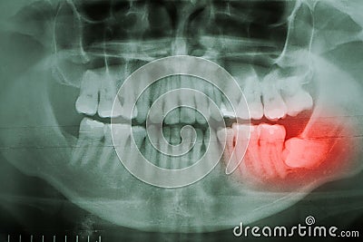 Dental X-Ray. A panoramic x-ray of a mouth Stock Photo