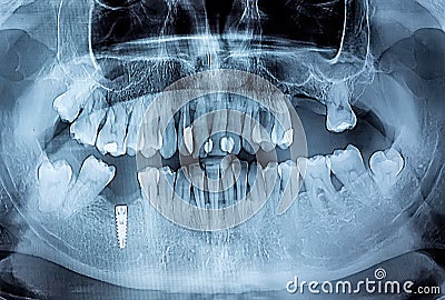 Dental x-ray with periodontitis problems, decayed teeth and implant Stock Photo