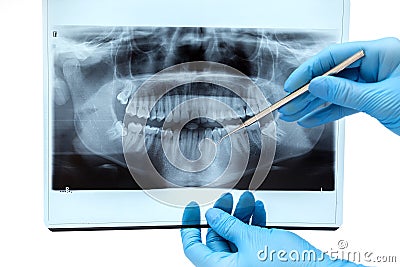 Dental X-ray Stock Photo
