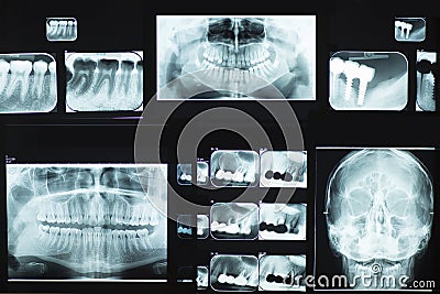 Dental X-Ray Stock Photo