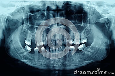 Dental X-Ray Showing Fillings in the Teeth Stock Photo