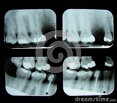 Dental x-rays Stock Photo