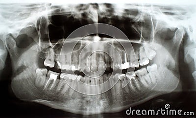 Dental xray Stock Photo