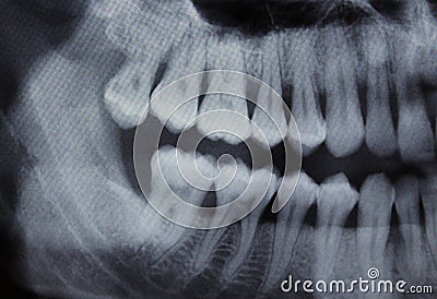 Dental Xray left half Stock Photo