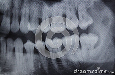 Dental Xray right half Stock Photo