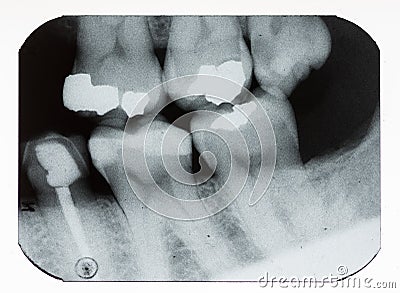 Dental xray Stock Photo