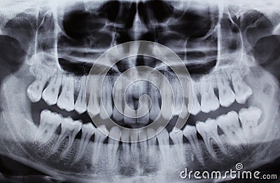 Dental Xray (x-ray) Stock Photo