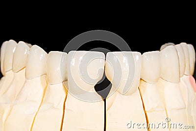 Dental zirconia bridge Stock Photo