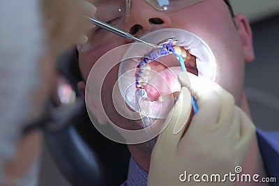 Dentist is applying blue gel on man`s teeth to find dental tartar and caries. Stock Photo