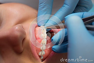 Dentist checking bracket at the braces on the female patient. Close-up. Real People. Stock Photo
