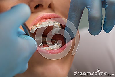 Dentist checking bracket at the braces on the female patient. Close-up. Real People. Stock Photo