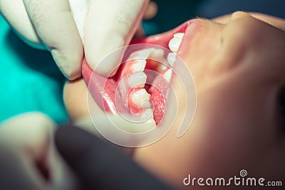 A dentist curing little girls teeth Stock Photo