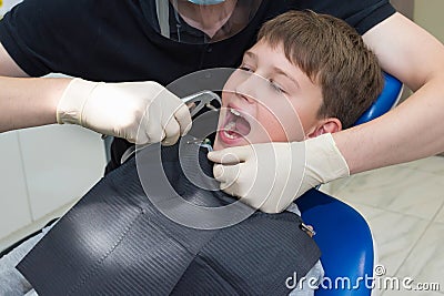 A dentist with dental forceps is pulling out an aching tooth Stock Photo