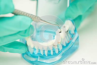 Dentist hand demonstrate to use dental tool cleaning caries Stock Photo