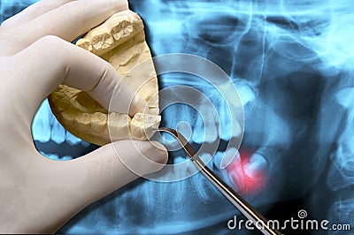 Dentist hand with orthodontic tool show wisdom teeth toothache Stock Photo