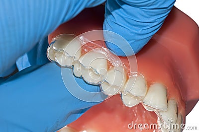 Dentist hand show invisible orthodontic aligner Stock Photo