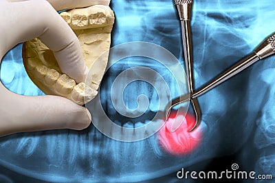 Dentist hand show molar tooth Stock Photo