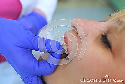 Dentist puts dental veneers patient and correction of teeth Stock Photo