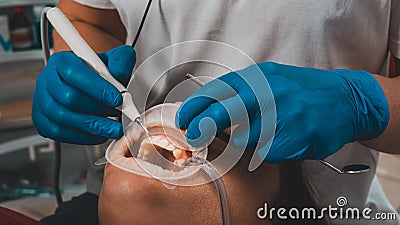 At the dentist`s appointment, tartar removal, use of ultrasound, patient and dentist. Retractor for isolation of lips and gums Stock Photo