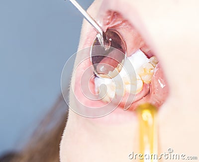 Dentist treating tooth Stock Photo