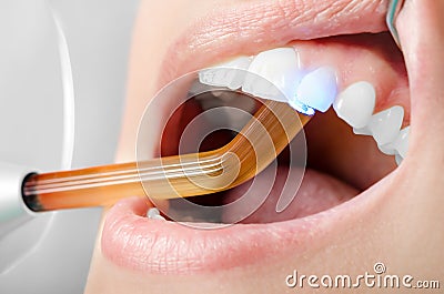 Dentist ultraviolet light pressed on teeth. Close up Stock Photo