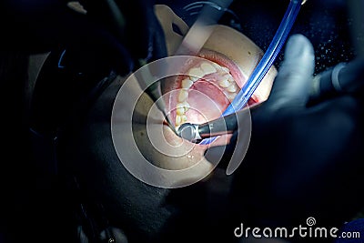 dentist uses a special instrument to restore a tooth. Stock Photo