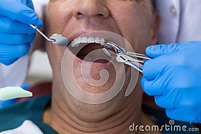 Dentist using surgical pliers to remove a decaying tooth Stock Photo