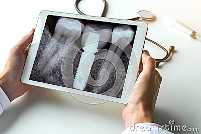 Dentist watching a dental x-ray teeth with dental pivot on digital tablet. Radiology concept Stock Photo