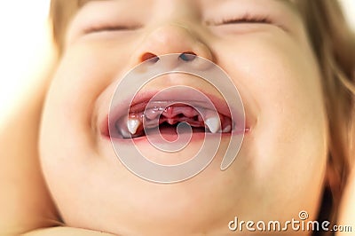Dentistry. Close-up of a beautiful little girl lying down and showing her mouth with her baby teeth removed. Child after tooth ext Stock Photo