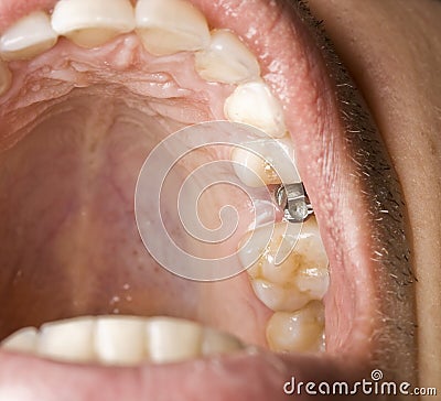 Dentistry implant Stock Photo