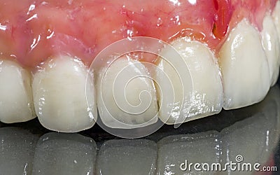 Denture, dental bridge Stock Photo