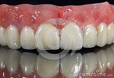 Denture, dental bridge Stock Photo