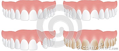 Denture upper plate. Broken, chipped, stained teeth Stock Photo