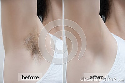 Depilation zone underarms. Stock Photo