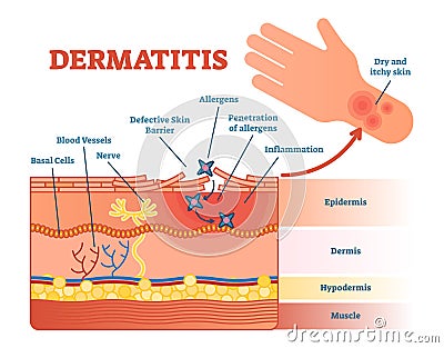 Dermatitis flat vector illustration diagram with skin layers and allergen movement. Educational medical information. Vector Illustration