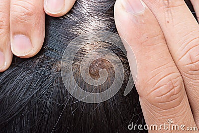 Dermatitis in hair or Skin disease on the head Stock Photo