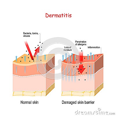 Dermatitis. Normal and skin with Damaged barrier. protection effect Vector Illustration
