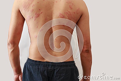 Dermatitis problem of rash ,Allergy rash Stock Photo