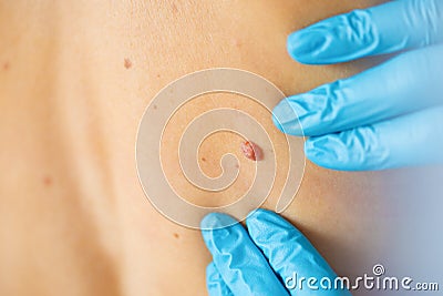 Dermatologist examine birthmark Stock Photo
