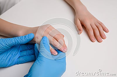 Dermatologist wearing blue gloves examines hand of child with many viral warts Verruca vulgaris, close-up Stock Photo