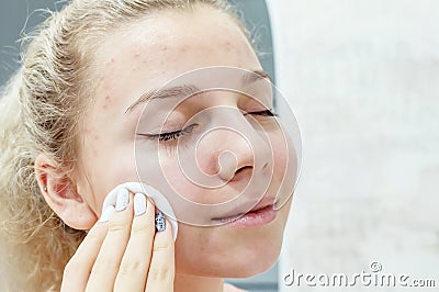 Dermatology. A beautiful girl with pimples on her face wipes the skin with a therapeutic agent on a cotton pad. Stock Photo