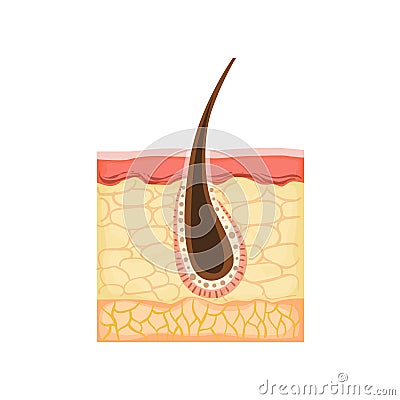 Dermatology Skincare Anatomical Info Illustration Demonstrating Skin Problem Development With Hair Root Inflammation Vector Illustration